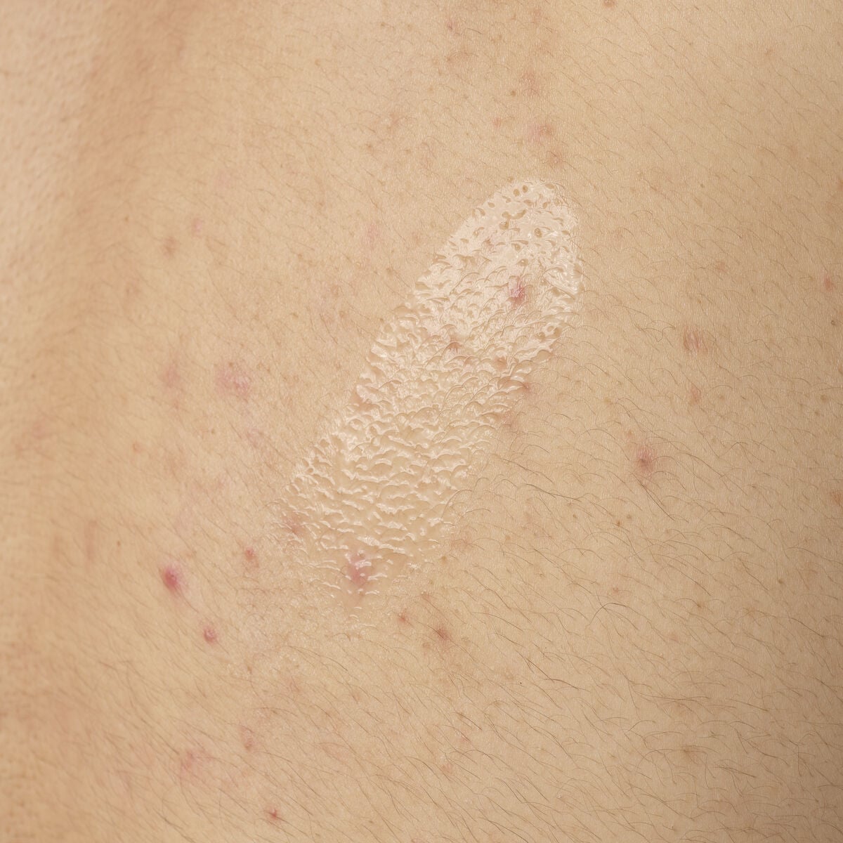 salicylic-acid-0-5-body-serum-d8 ORD-salicylic-acid-05-body-240ml-application.jpg
