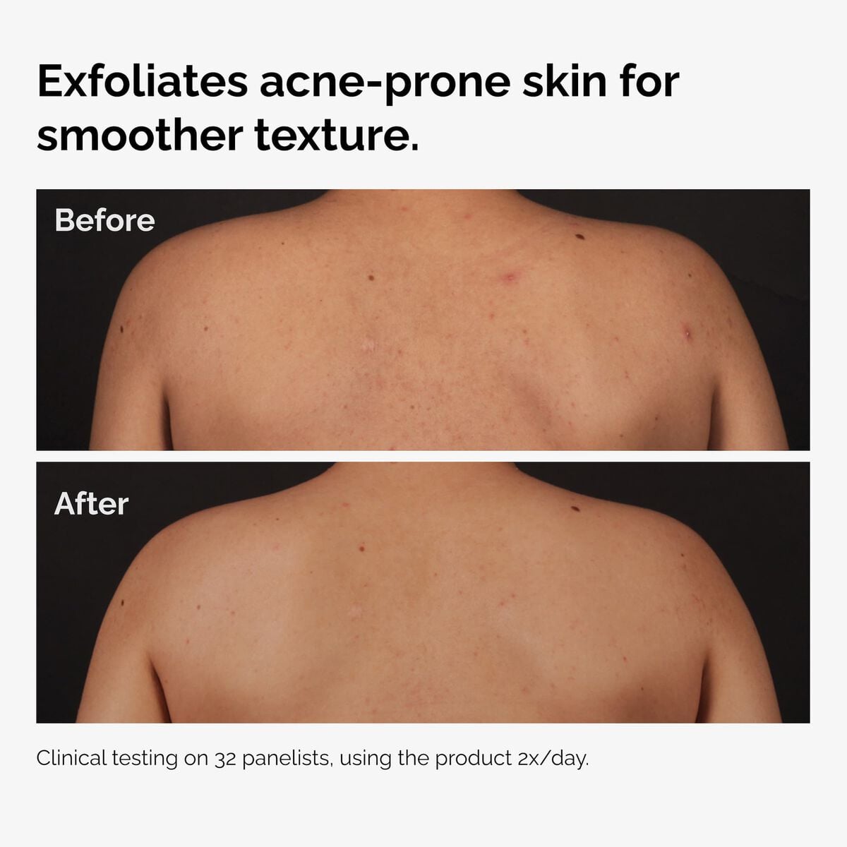 salicylic-acid-0-5-body-serum-d8 ord-salicylic-acid-body-serum-before-after-graphic-NA.jpg