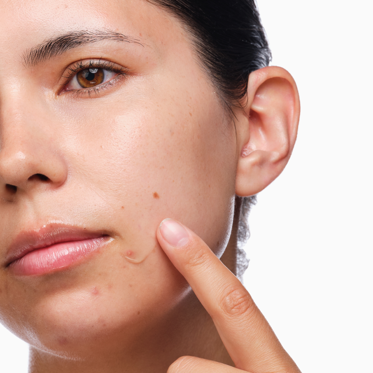 the-acne-set-e4 rdn-the-acne-set-application.png